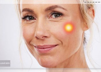 اندولیفت برای جای جوش