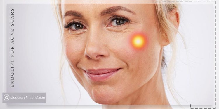 اندولیفت برای جای جوش