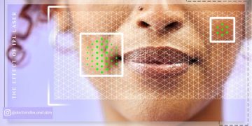 تأثیر لیزر آی ‌پی ‌ال برای لک صورت