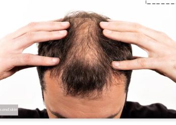 آلوپسی چیست