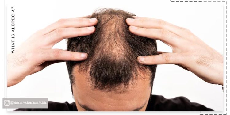 آلوپسی چیست