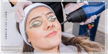 لیزر اربیوم یاگ برای درمان لک صورت
