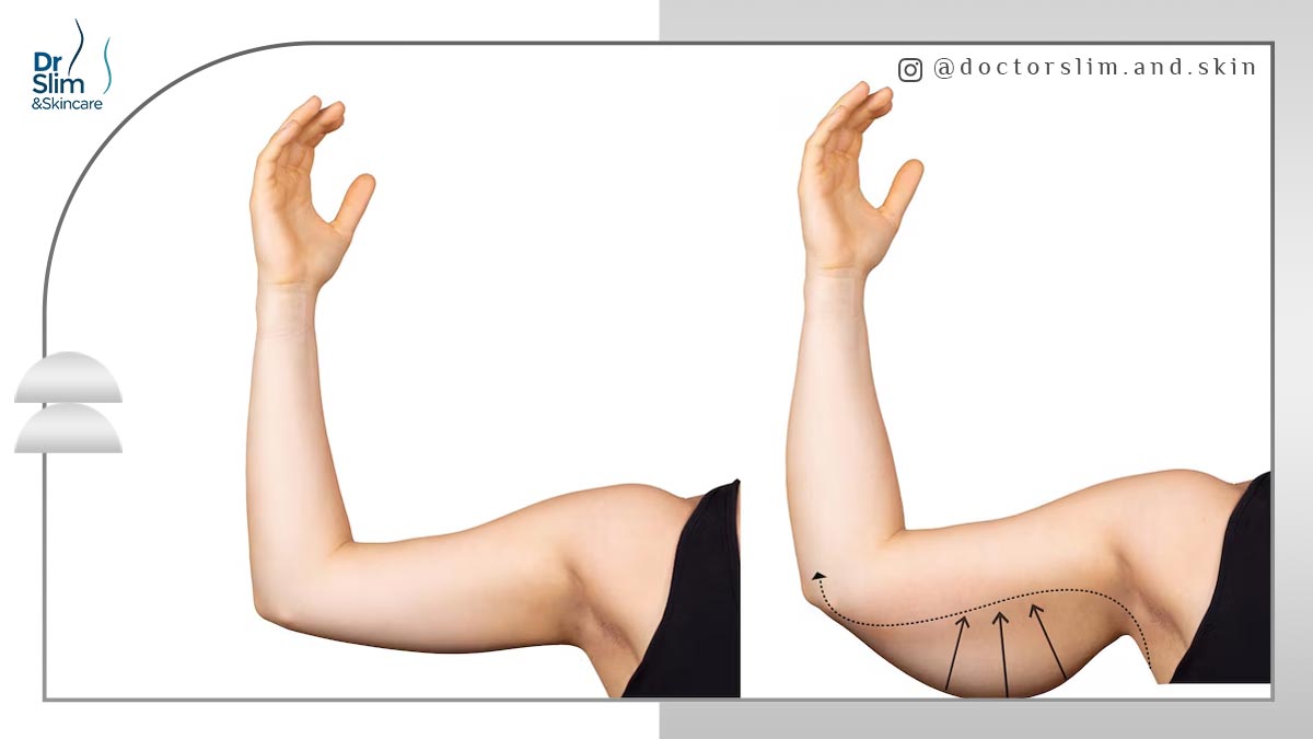 سریع ‌ترین راه برای لاغری بازو
