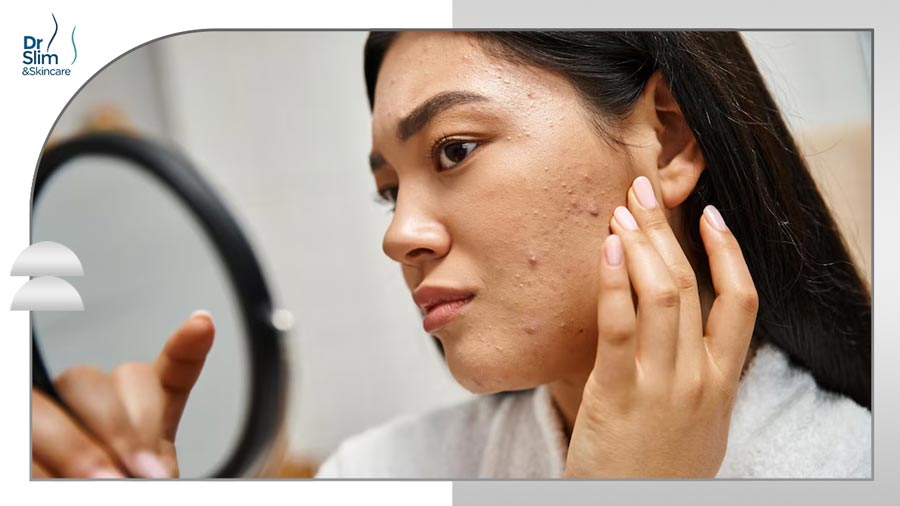 درمان اسکار جوش