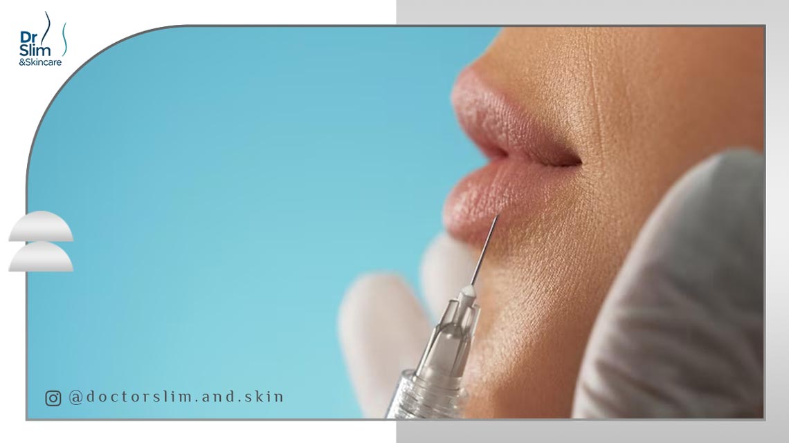 بوتاکس دور لب