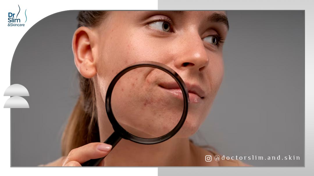 از بین بردن لکه‌ های قهوه ‌ای جای جوش