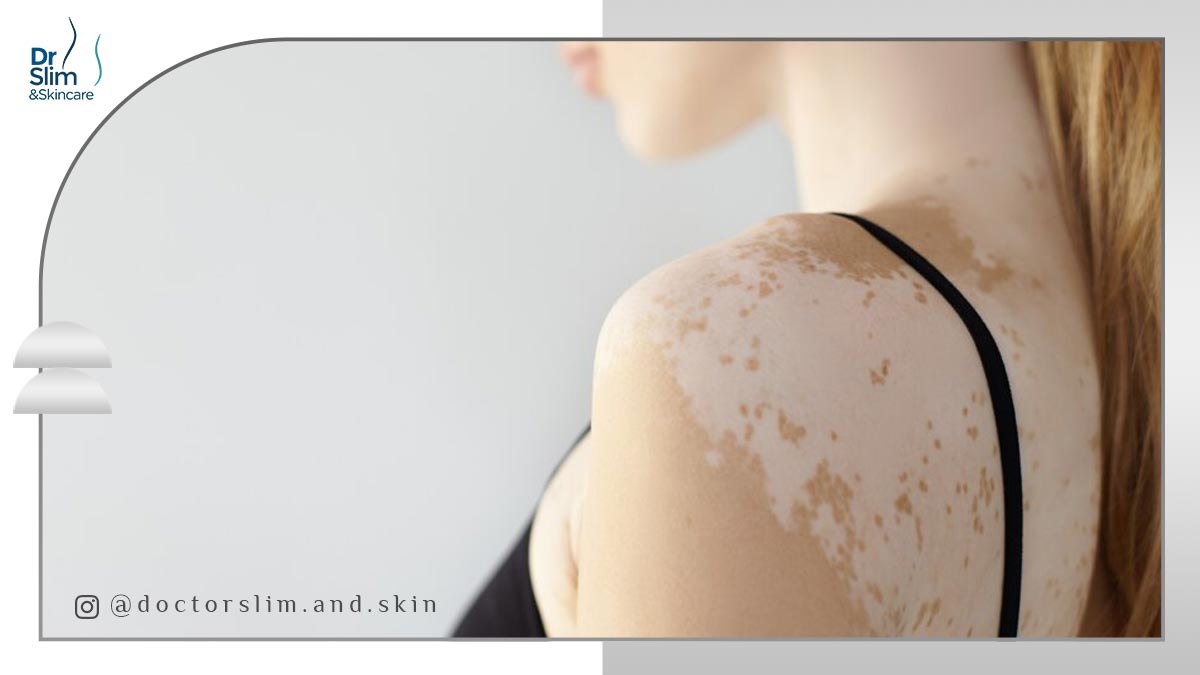 لک سفید روی پوست