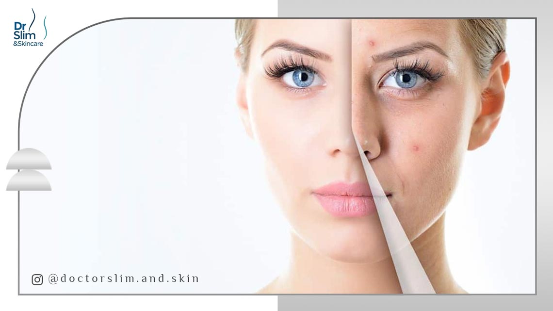 اندولیفت برای جای جوش