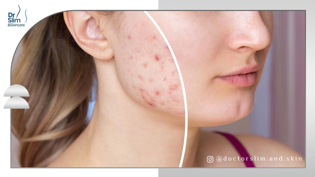 تأثیر لیزر آی پی ال برای لک صورت