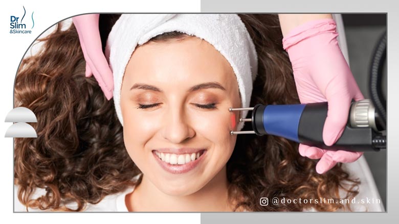 لیزر اربیوم یاگ برای درمان لک صورت