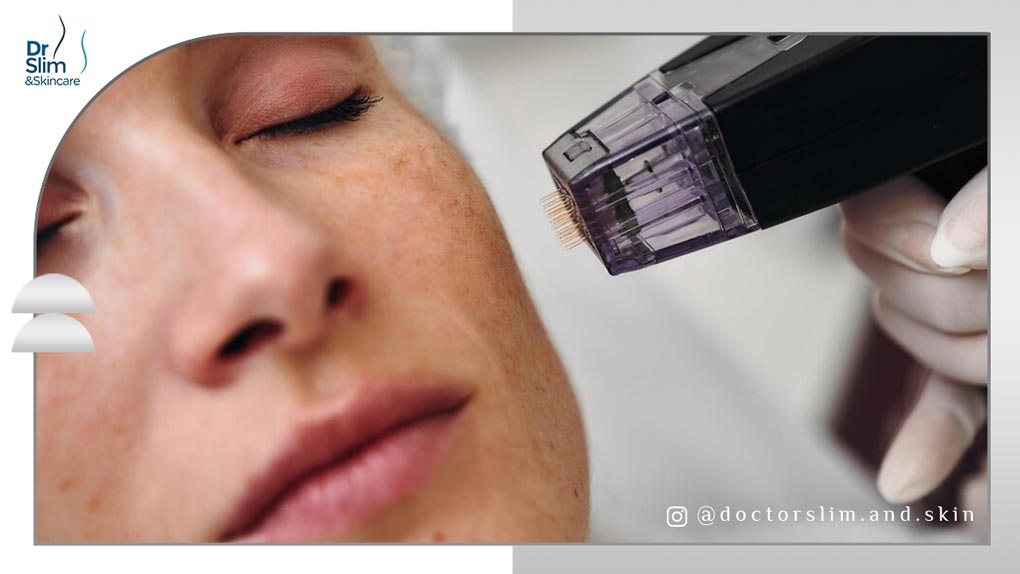 از بین بردن لکه های قهوه ای صورت با لیزر