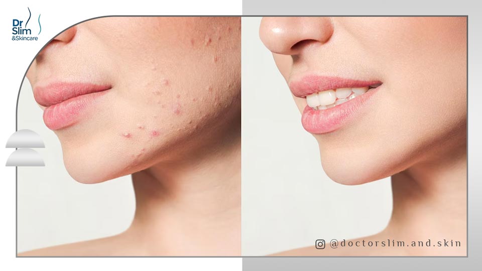 درمان اسکار جوش