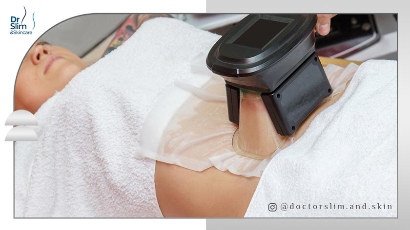 حذف چربی های اضافی زیر پوست با کول اسکالپتینگ