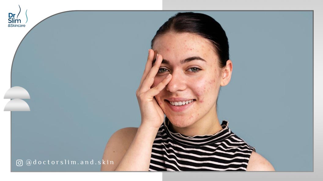 از بین بردن لکه‌ های قهوه ‌ای جای جوش