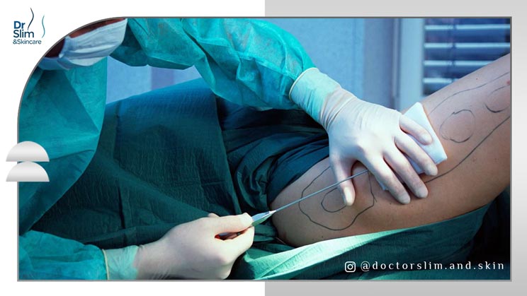 کول اسکالپتینگ و لیپوساکشن