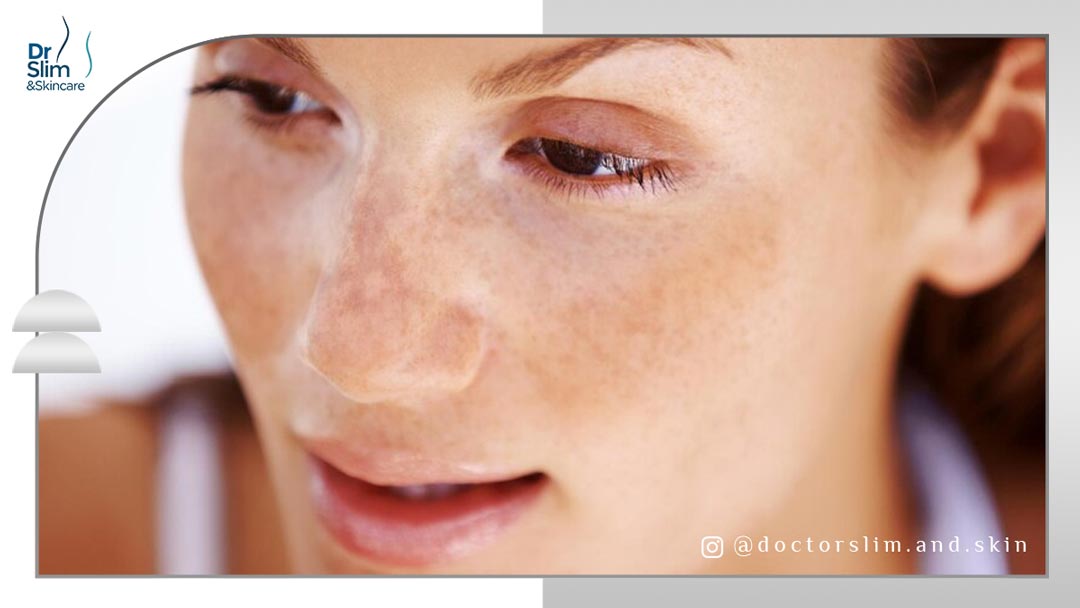 لک سفید روی پوست