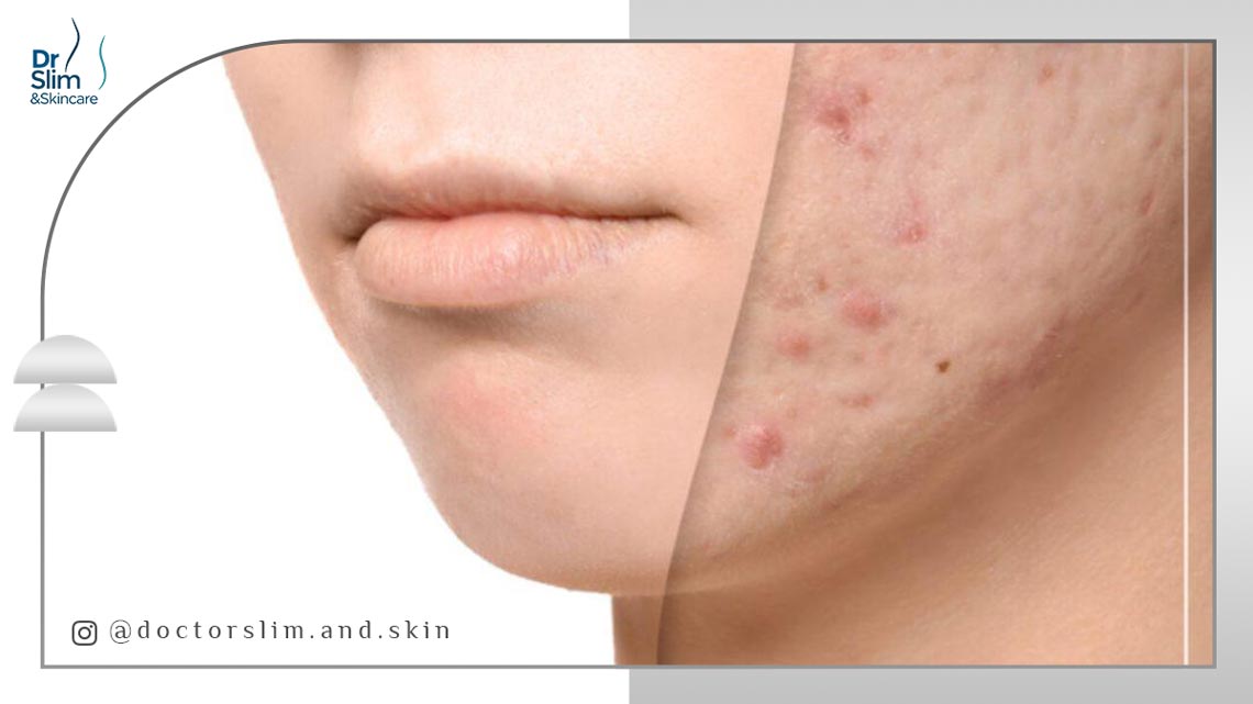 اندولیفت برای جای جوش