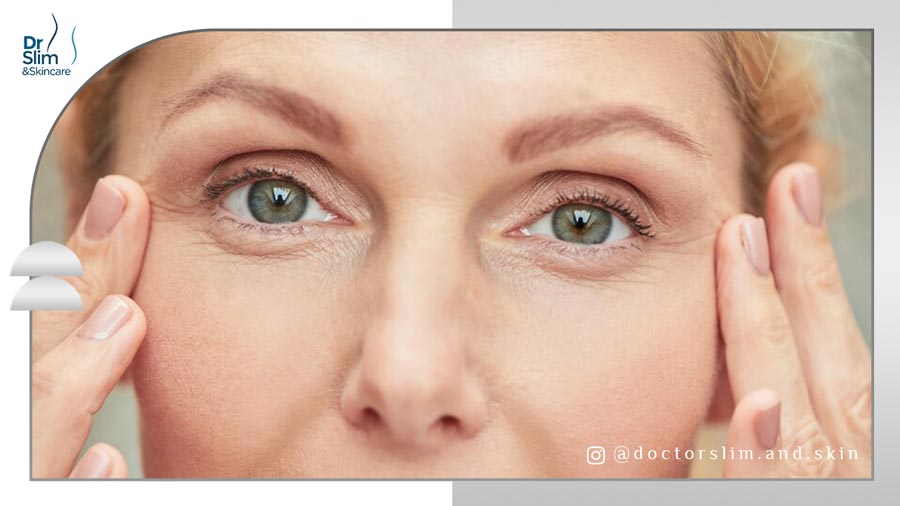 چین و چروک زیر چشم