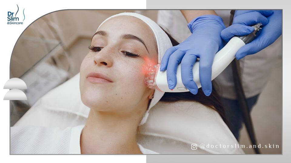 تأثیر لیزر آی پی ال برای لک صورت