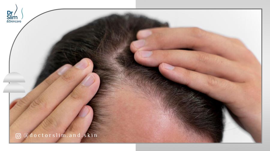 آلوپسی چیست