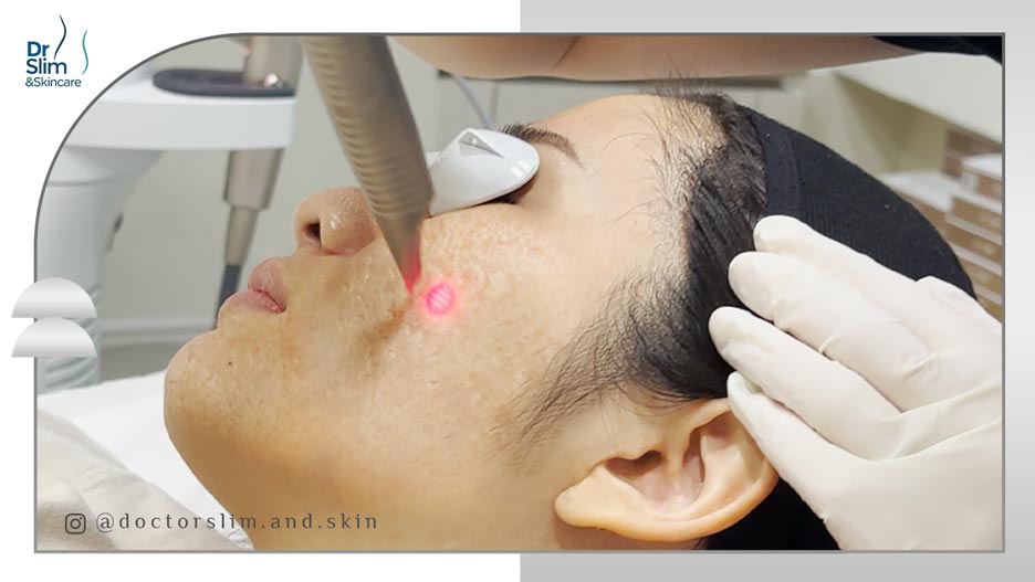لیزر اربیوم یاگ برای درمان لک صورت
