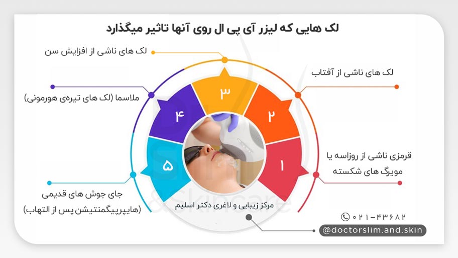 تأثیر لیزر آی پی ال برای لک صورت