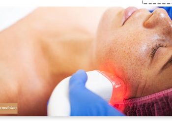 بهترین لیزر برای هایپرپیگمنتیشن صورت