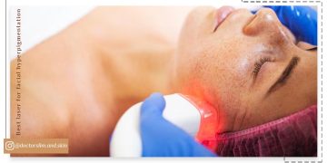 بهترین لیزر برای هایپرپیگمنتیشن صورت