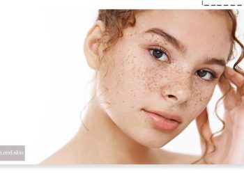 بهترین درمان لک قهوه ‌ای صورت