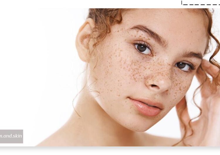 بهترین درمان لک قهوه ‌ای صورت