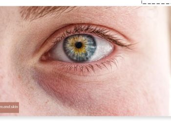 دلایل سیاهی زیر چشم