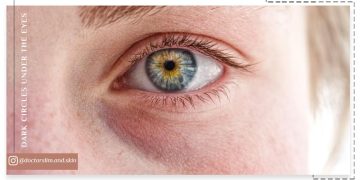 دلایل سیاهی زیر چشم