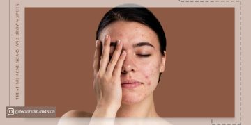 درمان جای جوش و لکه‌ های قهوه ‌ای