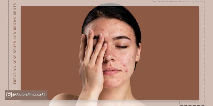 درمان جای جوش و لکه های قهوه ای