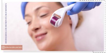 درمارولر از بین برنده لک و جای زخم و جوش صورت