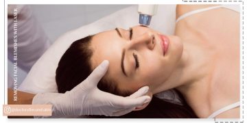 از بین بردن لک صورت با لیزر