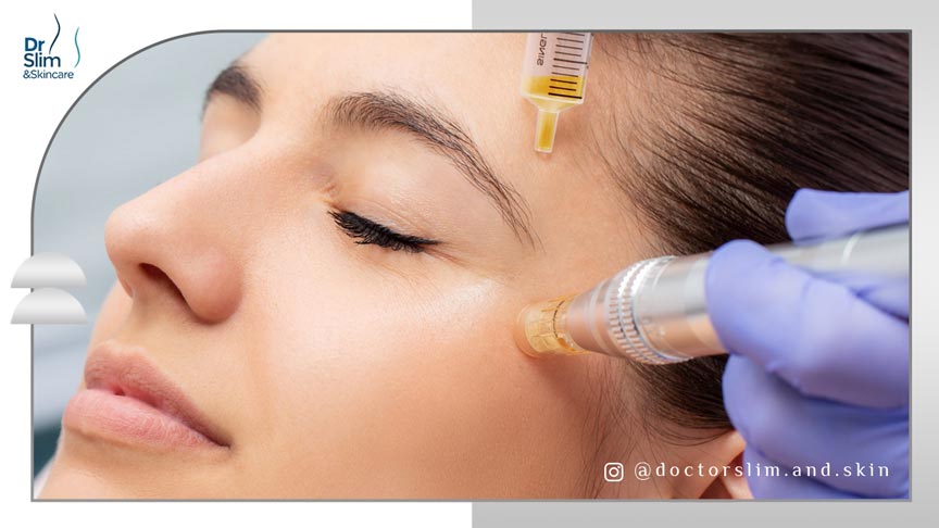 از بین بردن لک صورت با مزوتراپی