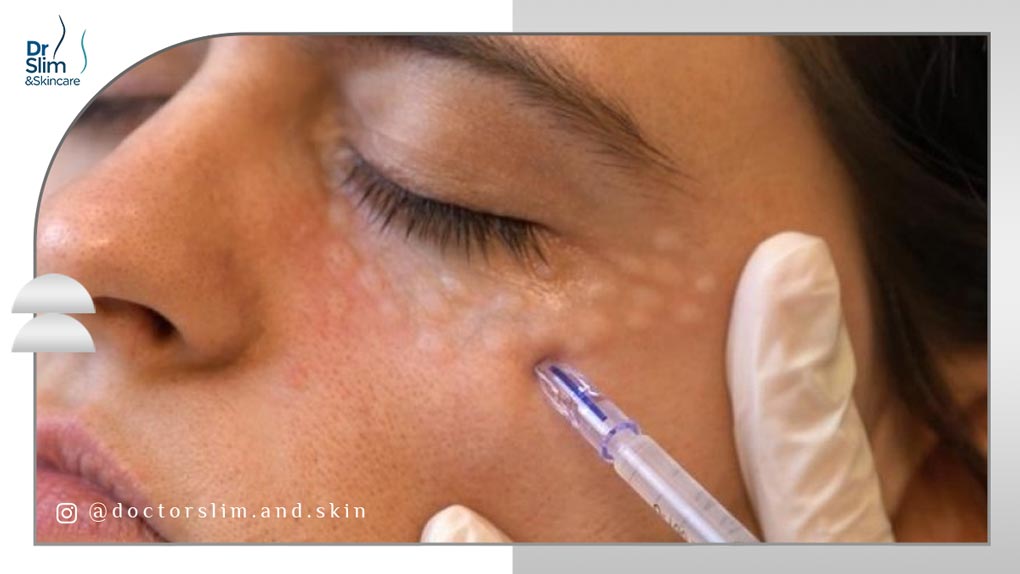 بهترین مزو برای جوانسازی زیر چشم