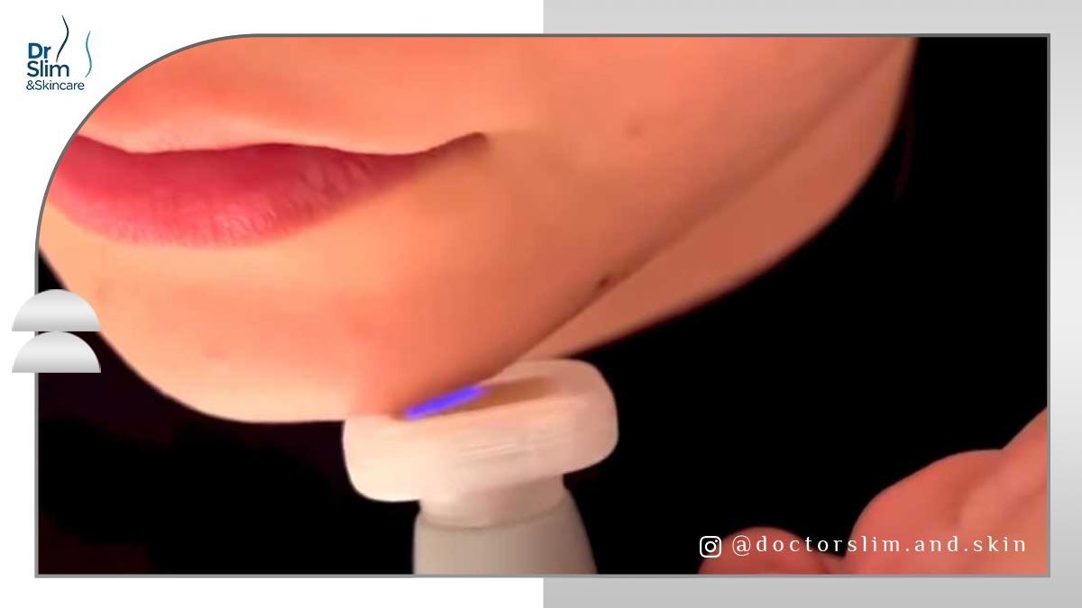 رفع غبغب با پلاسما جت