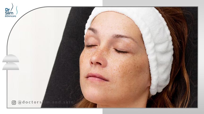 بهترین درمان لک قهوه ای صورت