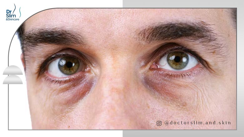 دلایل سیاهی زیر چشم