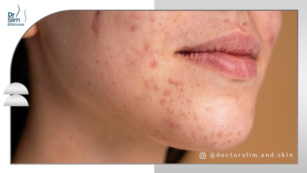 درمان جای جوش و لکه های قهوه ای