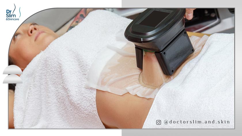 مزایای لاغری موضعی با کرایولیپولیز