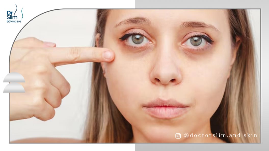 روغن سیاه دانه برای پف زیر چشم