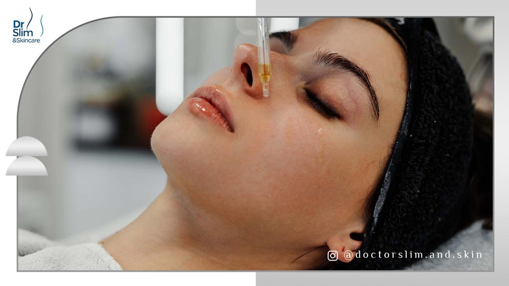 از بین بردن لک صورت با مزوتراپی