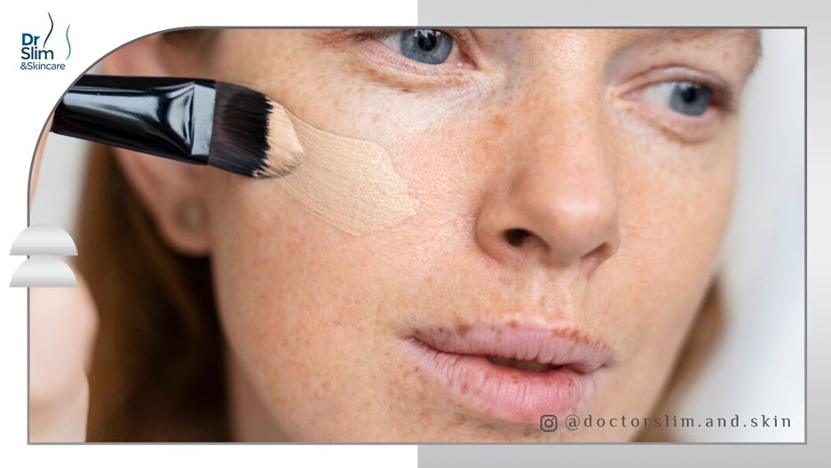 بهترین کرم برای لک قهوهای صورت