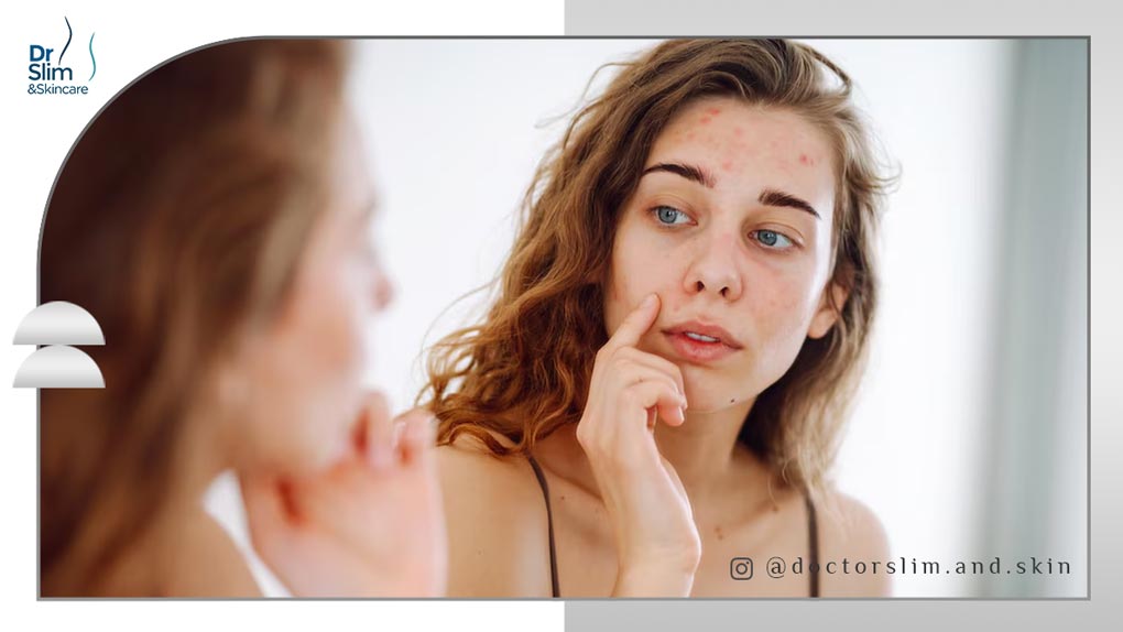 درمان جای جوش و لکه های قهوه ای