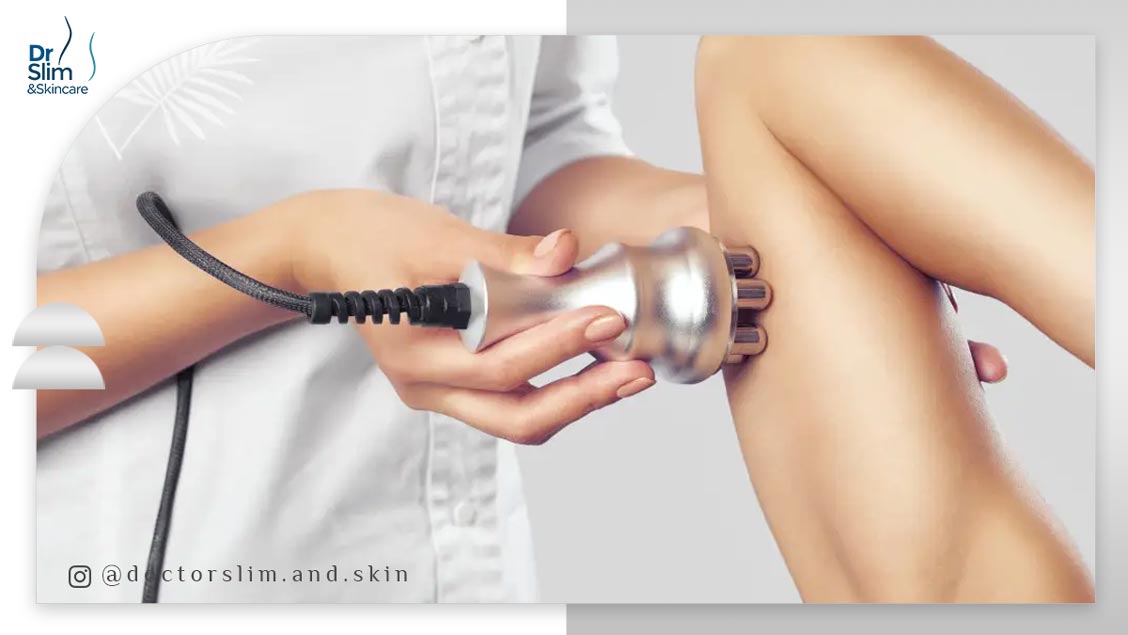 کویتیشن بهتر است یا آر اف