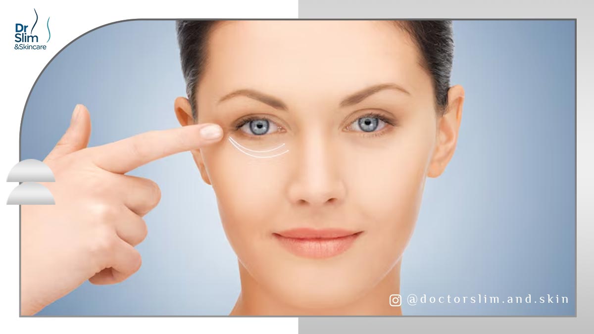 بوتاکس برای گودی زیر چشم