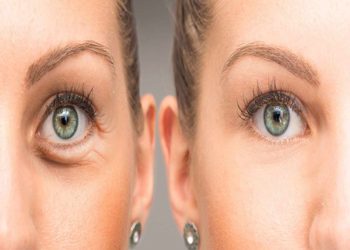 بوتاکس دور چشم